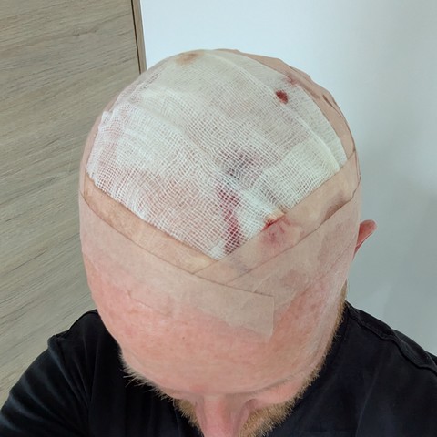 My bonce covered in gauze